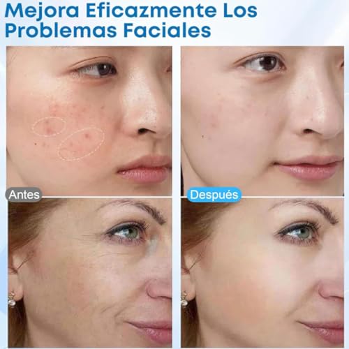 Fraktionierte Mikronadelmaschine – Facelifting, Hautstraffung, RF-Dehnungsstreifenentfernung, Verjüngung mit 2 Griffen für Faltenentfernungstherapie