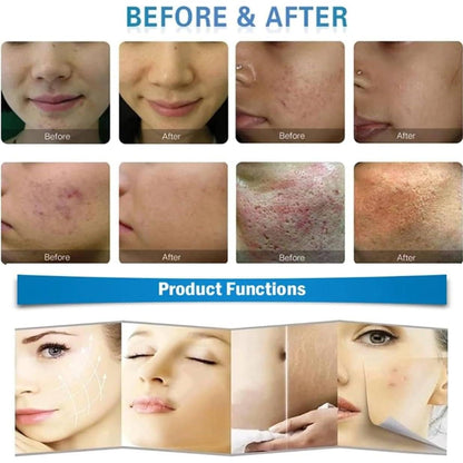 Professionelle fraktionierte Microneedling-Gesichtslifting-Maschine – RF-Hautstraffung, Akne-Reparatur & Hautpflege Beauty Machine