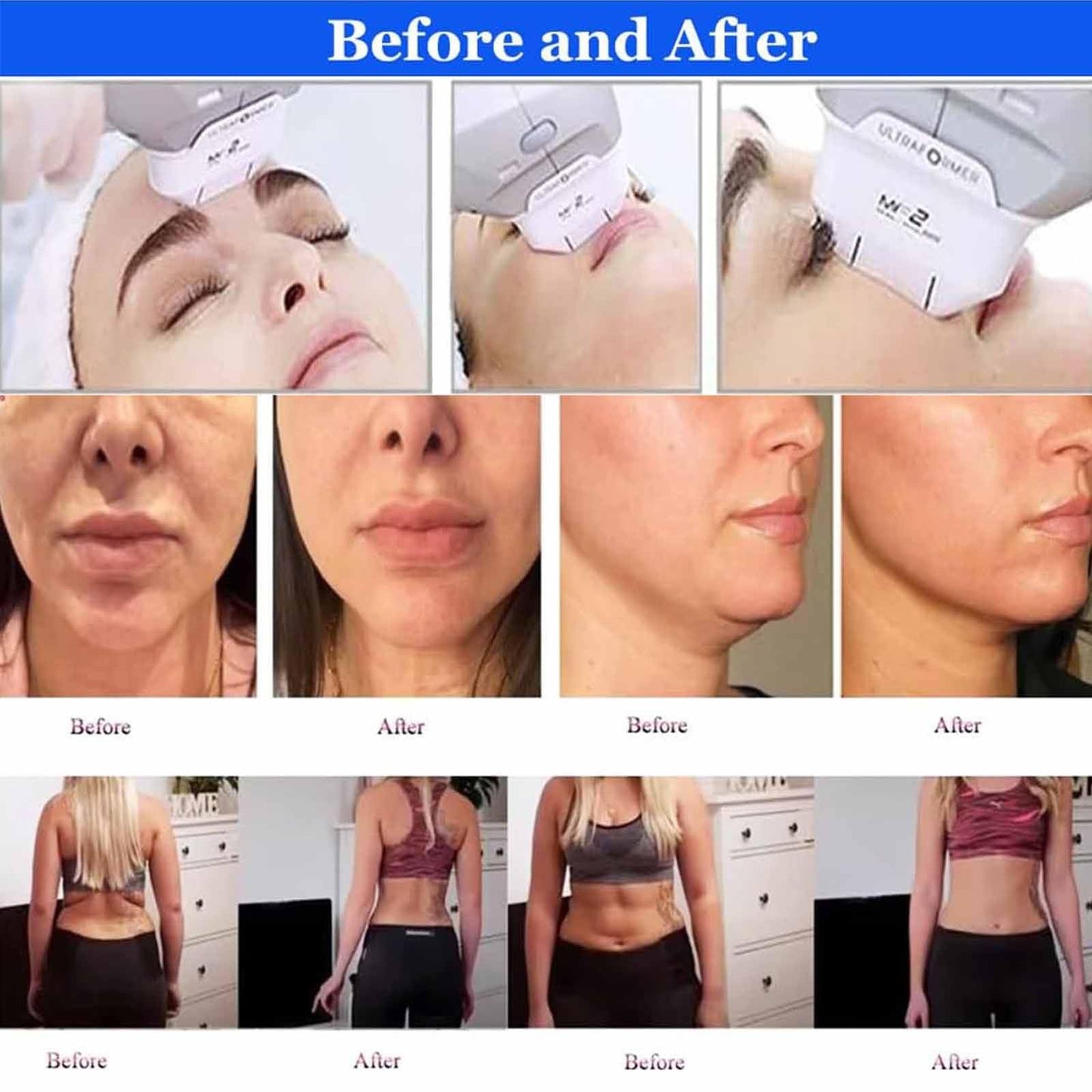 Professionelles 7-in-1 Hifu-Gerät für Gesicht & Körper – Tiefen 1,5–13 mm, MF2-Kartusche für feine Fältchen, nicht-invasiv, sicher, medizinisch