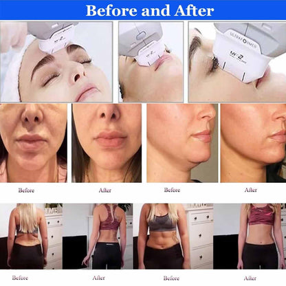 Professionelles 7-in-1 Hifu-Gerät für Gesicht & Körper – Tiefen 1,5–13 mm, MF2-Kartusche für feine Fältchen, nicht-invasiv, sicher, medizinisch