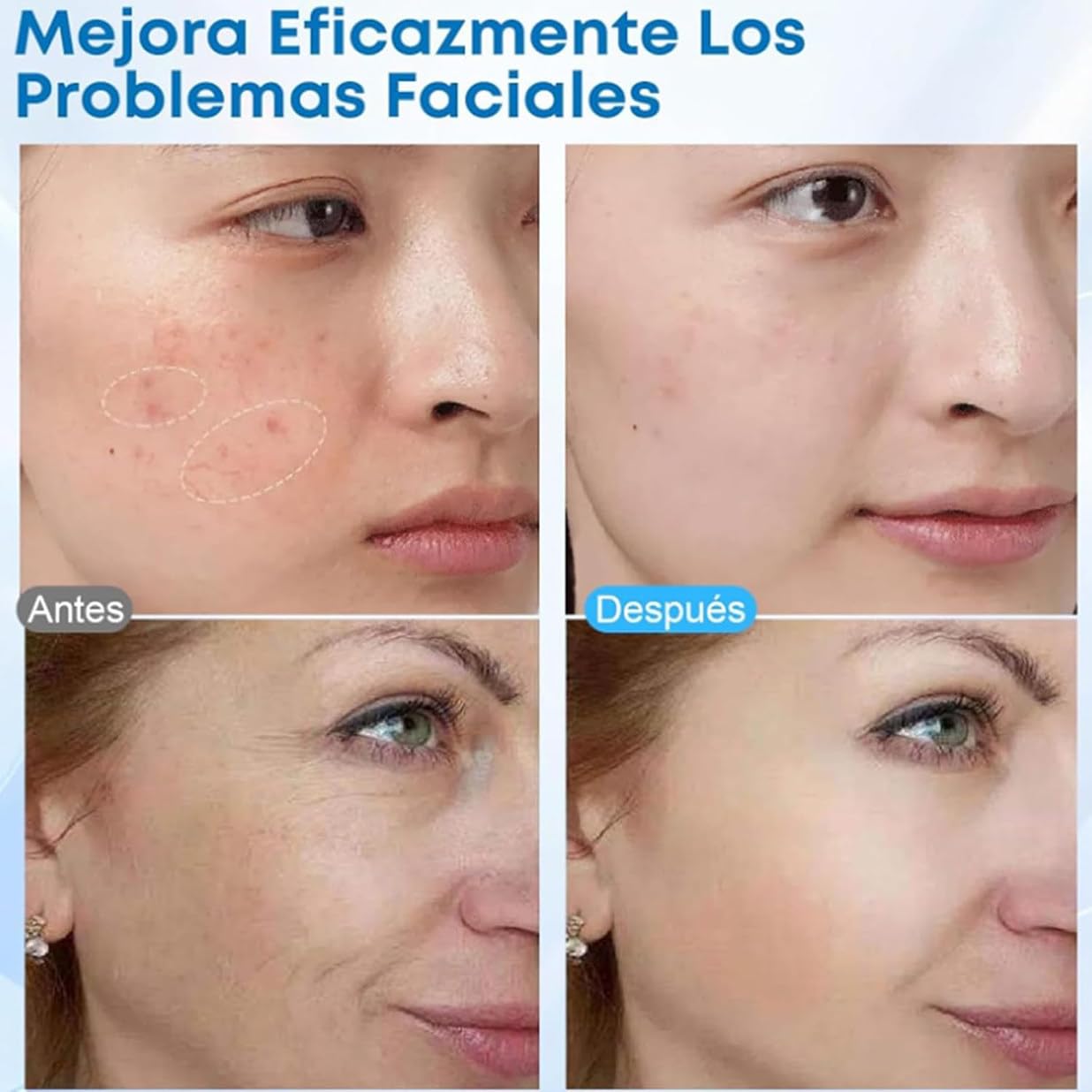 Fraktioniertes RF-Mikronadelgerät – Narben- & Dehnungsstreifenentfernung, Facelifting, Anti-Aging & Faltenentfernung