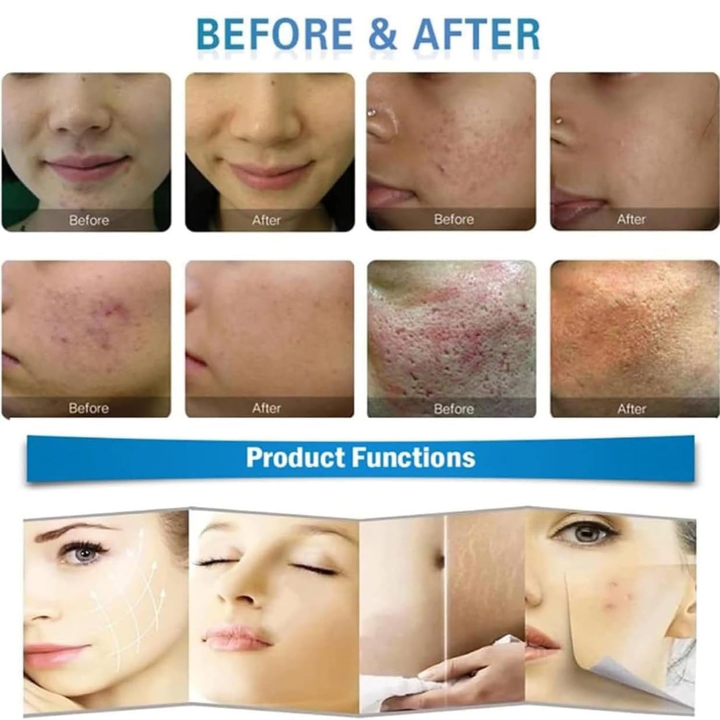 Fractional RF Microneedling Gerät – Gesichtsverjüngung, RF-Hautstraffung, Akne-Reparatur & professionelle Faltenentfernung