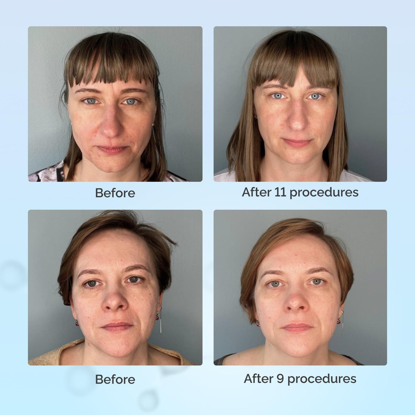 GESS FaceActive Professional BMS Gesichtsmassagegerät – Anti-Aging, Hautstraffung, Faltenreduzierung & Tiefengewebe-Massage mit Video-Tutorial