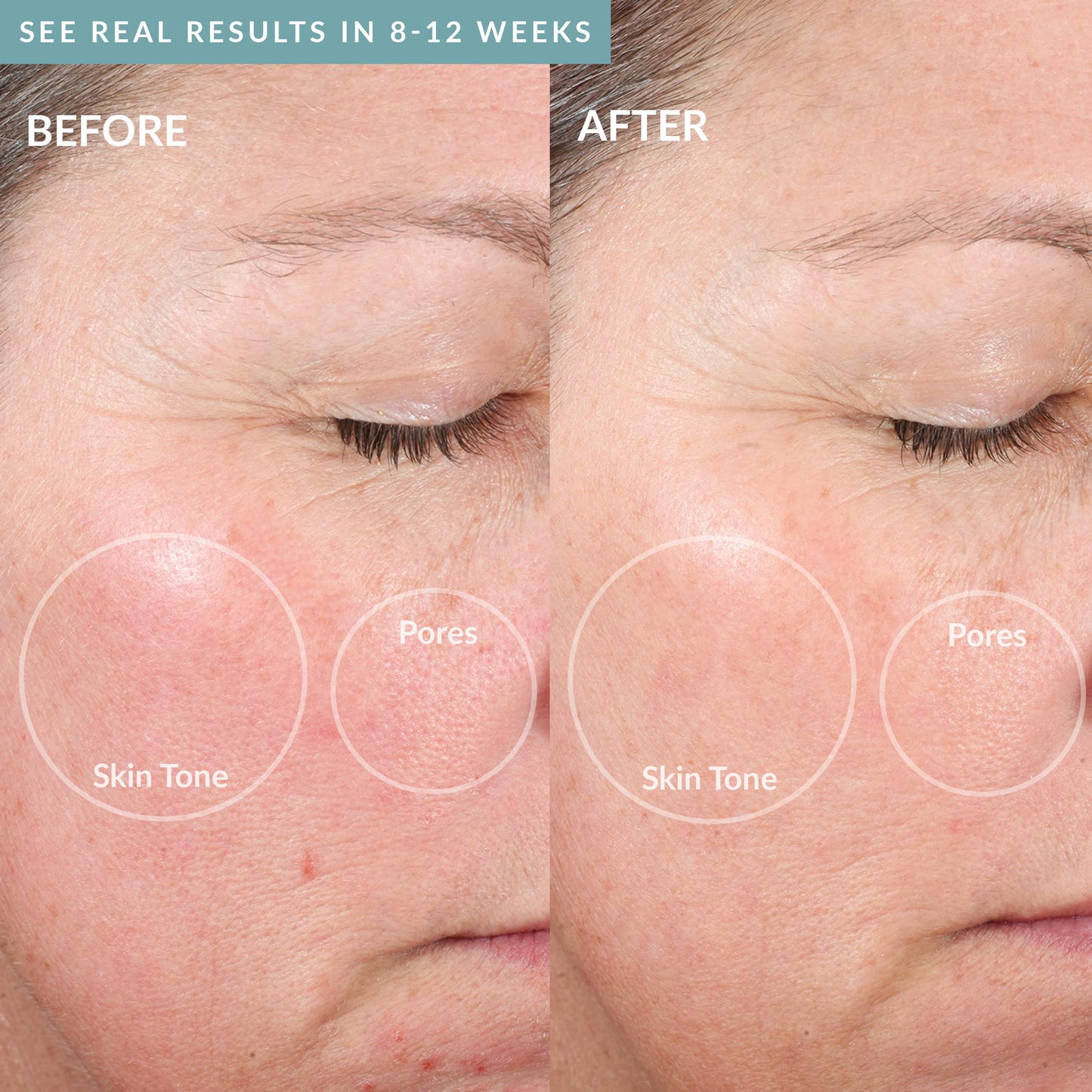 Persönliches Microderm Elite Pro